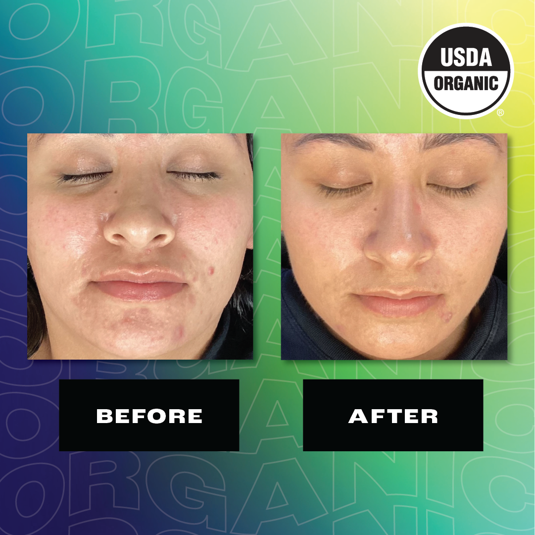 Split-comparison image showing the effects of a HYP Daily Repairing mist on a woman's face. The left side is labeled 'BEFORE' and shows the woman's face with visible acne and blemishes. The right side, labeled 'AFTER,' displays the same woman with a noticeably clearer complexion. Both images are taken from a similar angle, with the woman's eyes closed, to provide a consistent comparison. A 'USDA ORGANIC' seal is placed in the upper right corner of the after image.