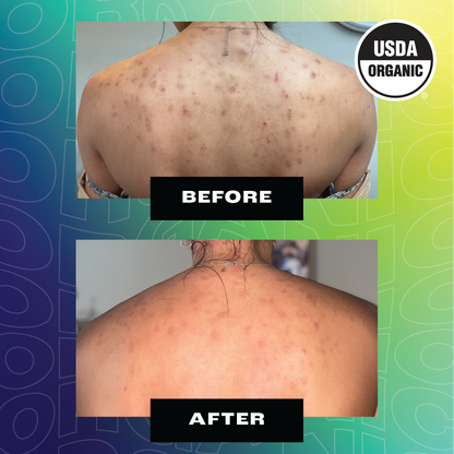 A split-image comparison showing the back of a person with skin blemishes. The top photo is labeled ‘BEFORE’ and depicts the back with numerous visible acne marks and scars. Directly below is another photo, also labeled 'AFTER,' showing the same back with a similar pattern of skin blemishes, suggesting an illustration of results over a period of time after using a skincare product. The background has a blue to green gradient design with the 'USDA ORGANIC' seal in the top right corner.